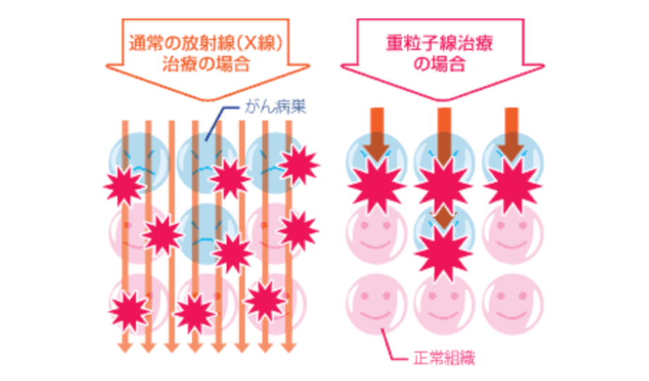 通常の放射線(X線)治療の場合と重粒子線治療の場合の違いを表すイメージ図