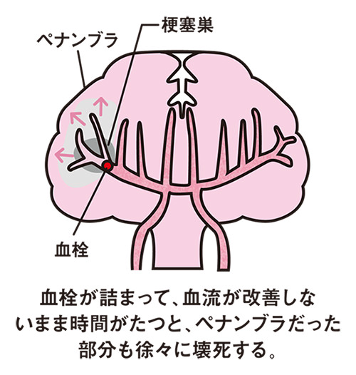 血栓が詰まって、血流が改善しないまま時間がたつと、ペナンブラだった部分も徐々に壊死する。