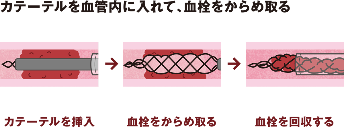 カテーテルを血管内に入れて、血栓をからめ取る