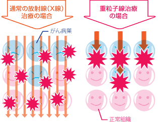 通常の放射線(X線)治療の場合と重粒子線治療の場合